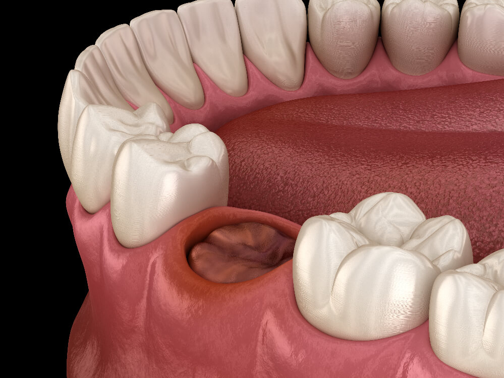 Infected Tooth Removal