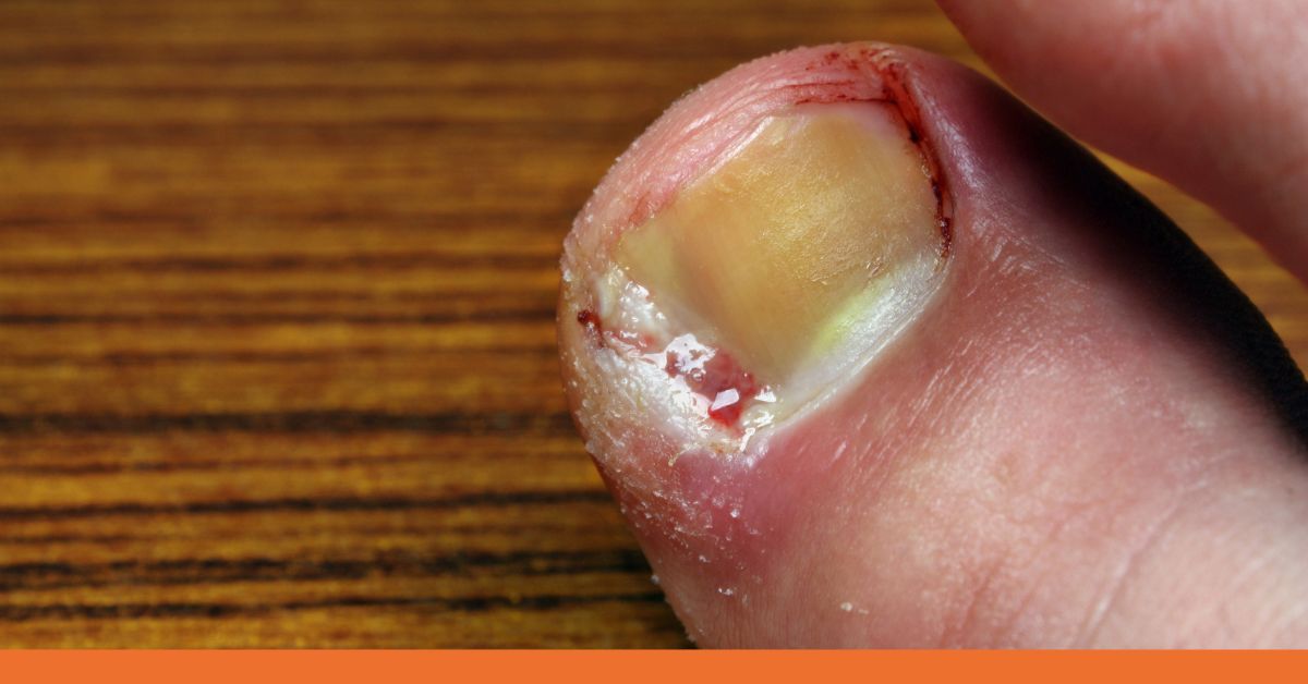 Toenail Trauma